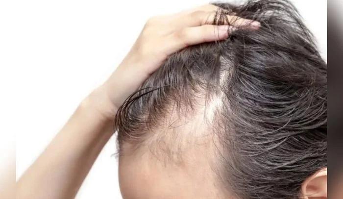 PÉRDIDA DE CABELLO: CAUSAS Y TRATAMIENTOS